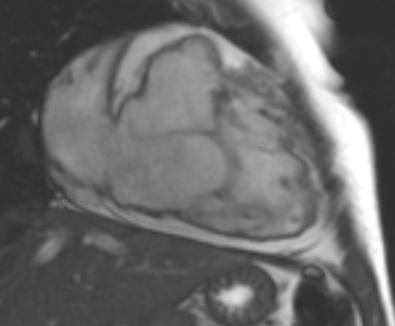 File:Arrhythmogenic right ventricular cardiomyopathy (Radiopaedia 69431-79307 2ch cine 41).jpg