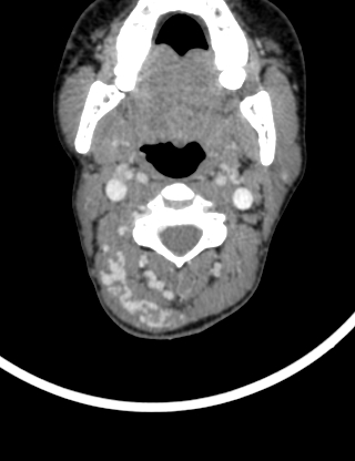 File:Arteriovenous malformation of the neck (Radiopaedia 53935-60062 B 15).jpg