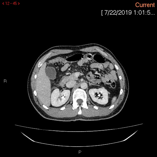 File:Ascending colonic diverticulum mimicking acute appendicitis (Radiopaedia 69943-80198 A 45).jpg