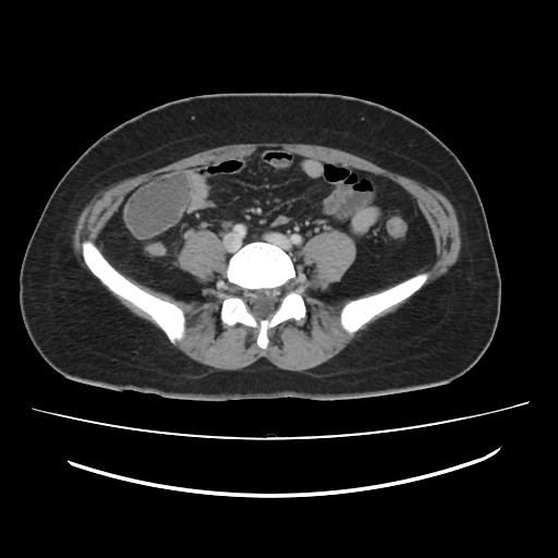 Ascending retrocecal appendicitis with liver abscesses (Radiopaedia 60066-67615 B 61).jpg