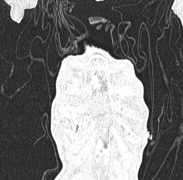 Aspergilloma- with Monod sign (Radiopaedia 44737-48532 Coronal lung window 120).jpg