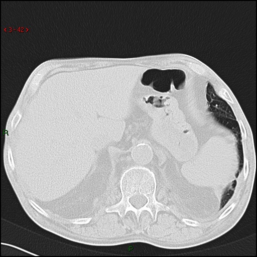 File:Aspergilloma (Radiopaedia 14842-14787 Axial lung window 42).jpg