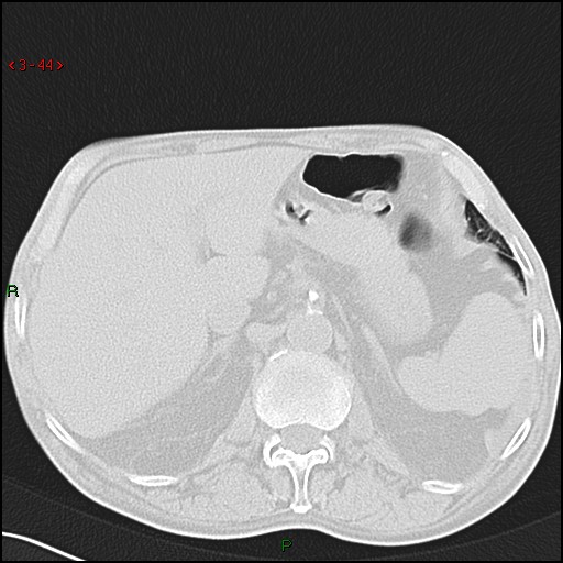 File:Aspergilloma (Radiopaedia 14842-14787 Axial lung window 44).jpg