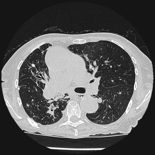 Aspergilloma (Radiopaedia 24458-24763 Axial lung window 30).jpg