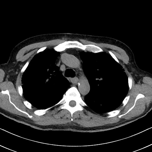 Aspergilloma on background pulmonary fibrosis (Radiopaedia 60942-68757 Axial non-contrast 20).jpg