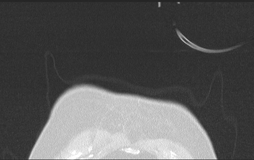 Aspirated tooth (Radiopaedia 28584-28844 Axial lung window 14).jpg