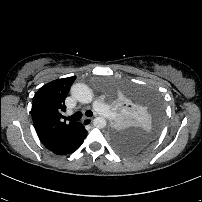 Aspiration pneumonia complicated by empyema (Radiopaedia 73024-83767 B 123).jpg