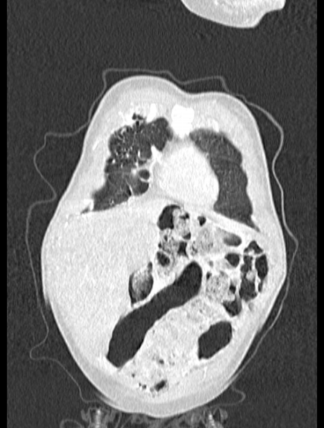 Asplenia syndrome (Radiopaedia 73083-83792 Coronal lung window 12).jpg