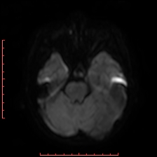 Astroblastoma (Radiopaedia 74287-85162 Axial DWI 30).jpg