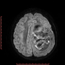 Astroblastoma (Radiopaedia 74287-85162 Axial DWI 74).jpg