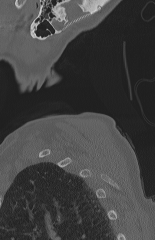 Atlanto-axial subluxation (Radiopaedia 36610-38176 Sagittal bone window 76).png