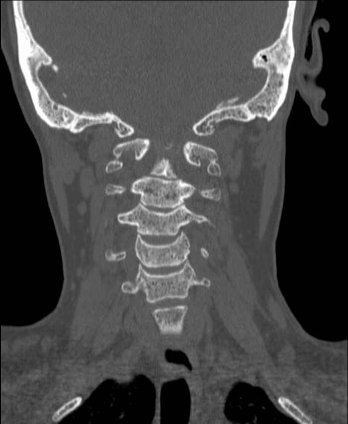 Atlanto-occipital assimilation with basilar invagination (Radiopaedia 70122-80188 Coronal bone window 108).jpg