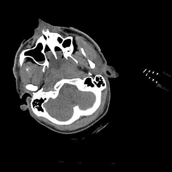 File:Atlanto-occipital dissociation (Traynelis type 1), C2 teardrop fracture, C6-7 facet joint dislocation (Radiopaedia 87655-104061 Axial non-contrast 3).jpg