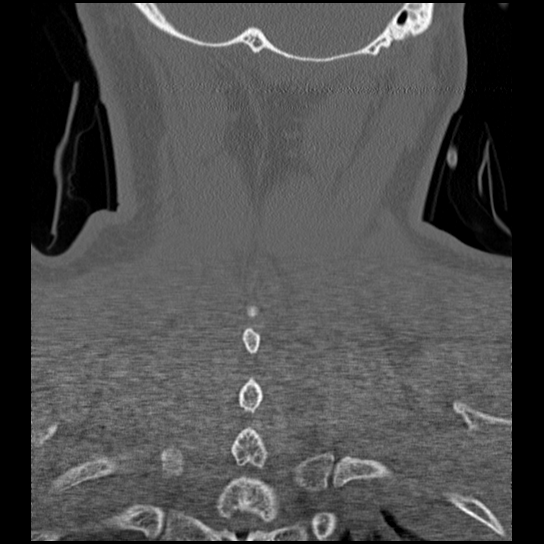Atlanto-occipital dissociation injury (Radiopaedia 29274-29698 Coronal bone window 5).png