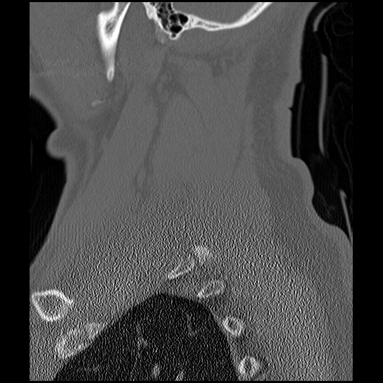 Atlanto-occipital dissociation injury (Radiopaedia 29274-29698 Sagittal bone window 51).png