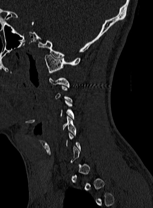 Atlantoaxial subluxation (Radiopaedia 44681-48450 Sagittal bone window 1).jpg