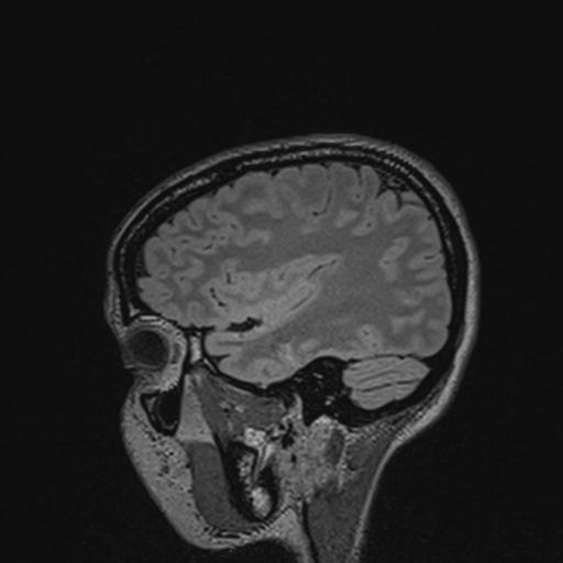Atretic encephalocoele with inferior vermis hypoplasia (Radiopaedia 30443-31108 Sagittal FLAIR 46).jpg