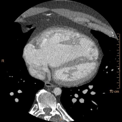 Atrial septal defect (upper sinus venosus type) with partial anomalous pulmonary venous return into superior vena cava (Radiopaedia 73228-83961 A 195).jpg