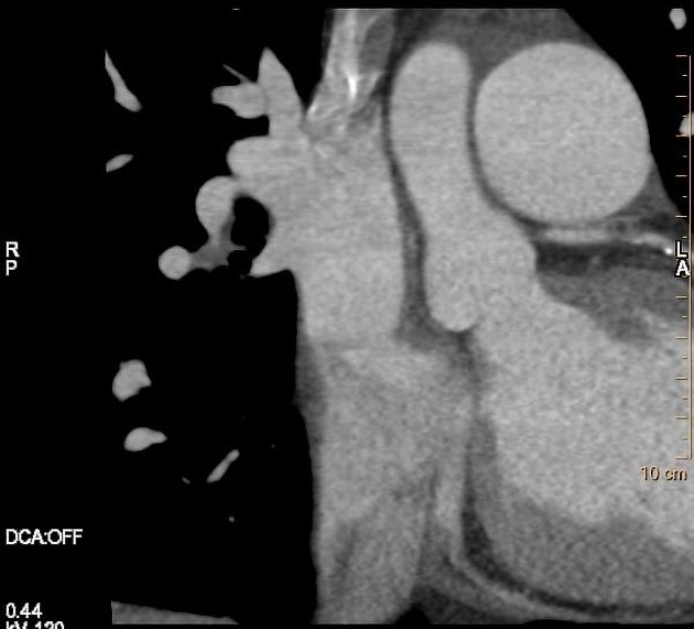 File:Atrial septal defect (upper sinus venosus type) with partial anomalous pulmonary venous return into superior vena cava (Radiopaedia 73228-84051 C+ arterial phase 1).jpeg