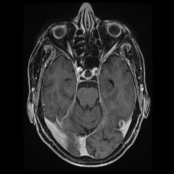 Atypical meningioma (Radiopaedia 45535-49629 Axial T1 C+ 30).jpg