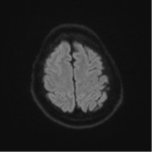 Atypical meningioma (WHO Grade II) (Radiopaedia 54742-60979 Axial DWI 51).png