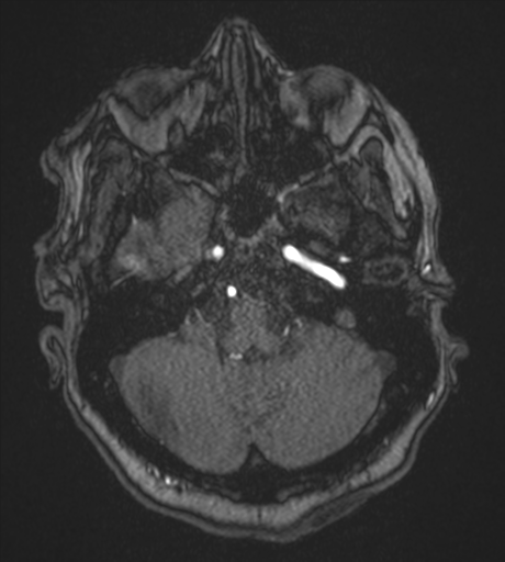 Atypical meningioma (WHO Grade II) (Radiopaedia 54742-60981 Axial MRA 21).png