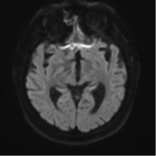 Atypical meningioma (WHO grade II) with brain invasion (Radiopaedia 57767-64729 Axial DWI 43).png