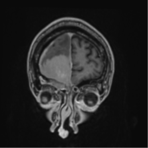 File:Atypical meningioma (WHO grade II) with brain invasion (Radiopaedia 57767-64729 Coronal T1 C+ 7).png