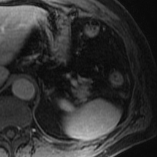 File:Atypical renal cyst on MRI (Radiopaedia 17349-17046 D 2).jpg