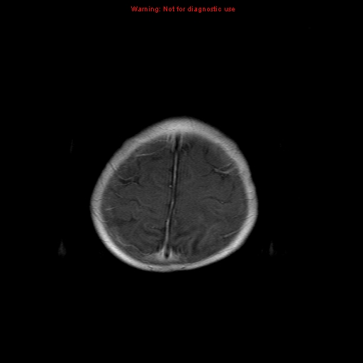 File:Atypical teratoid rhabdoid tumor (Radiopaedia 10712-11183 Axial T1 C+ 2).jpg