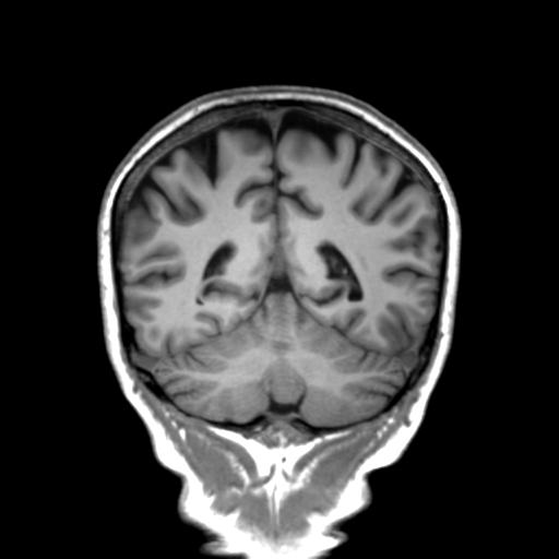 Autoimmune limbic encephalitis (Radiopaedia 30363-31005 Coronal T1 19).jpg