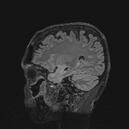 Autoimmune limbic encephalitis (Radiopaedia 30363-31005 Sagittal FLAIR 55).jpg