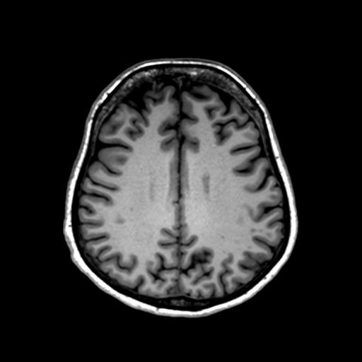 Autoimmune limbic encephalitis (Radiopaedia 30363-31005 T1 Axial 1mm 102).jpg