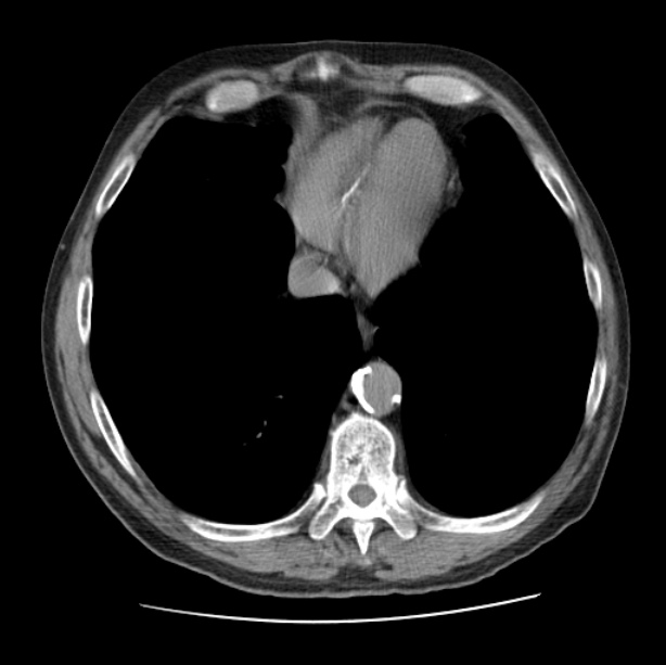 Autosomal dominant polycystic kidney disease (Radiopaedia 27851-28094 Axial non-contrast 43).jpg