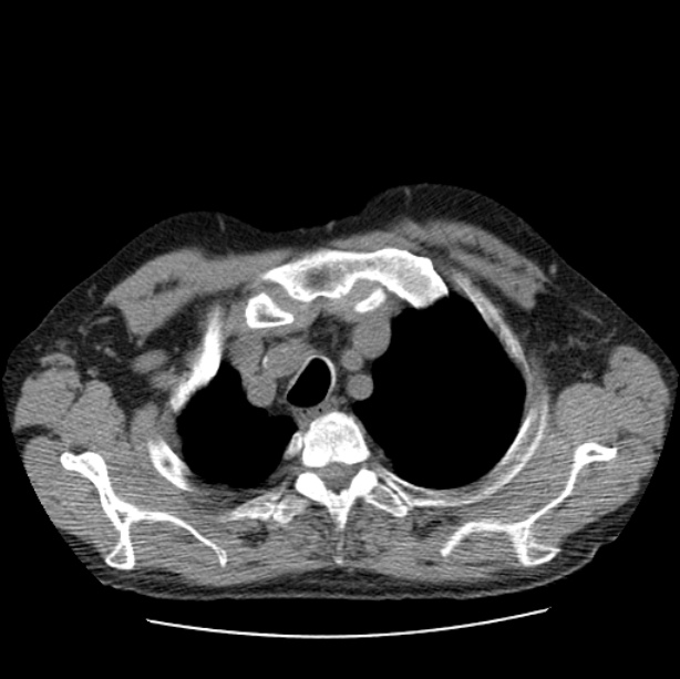 Autosomal dominant polycystic kidney disease (Radiopaedia 27851-28094 Axial non-contrast 8).jpg