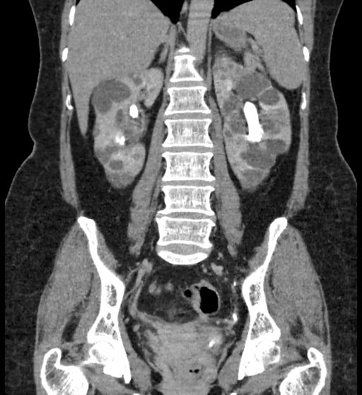 File:Autosomal dominant polycystic kidney disease (Radiopaedia 38189-40194 Coronal C+ delayed 62).jpg