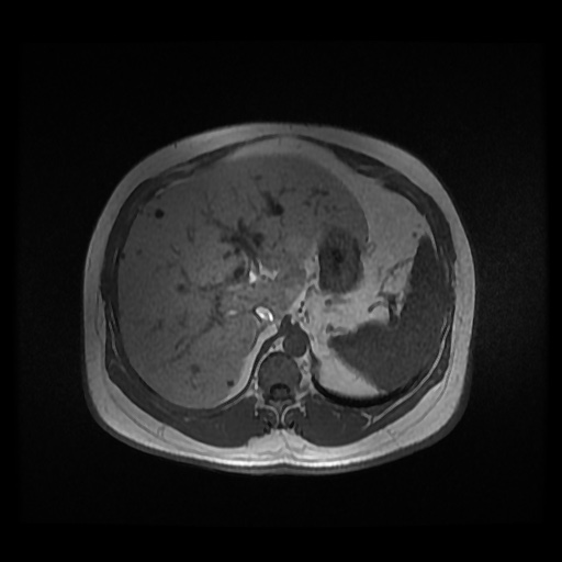 Autosomal dominant polycystic kidney disease (Radiopaedia 50259-55611 Axial 2D Dual Echo 28).jpg
