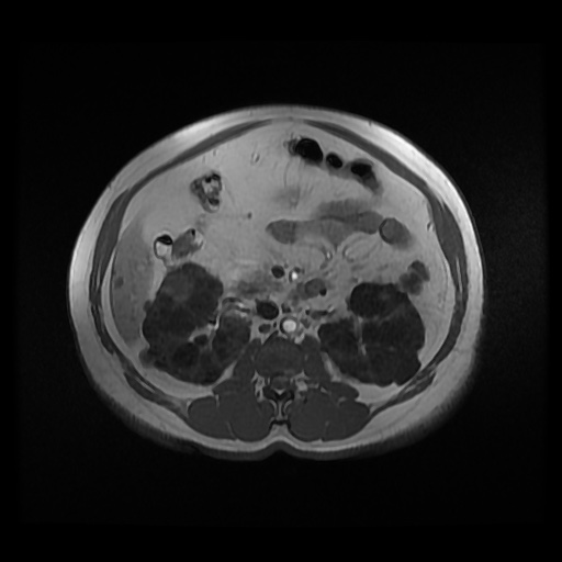Autosomal dominant polycystic kidney disease (Radiopaedia 50259-55611 Axial 2D Dual Echo 46).jpg