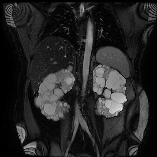 File:Autosomal dominant polycystic kidney disease (Radiopaedia 50259-55611 Coronal FIESTA 21).jpg