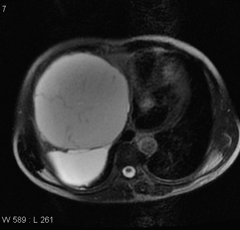 File:Autosomal dominant polycystic kidney disease (Radiopaedia 5202-6969 Axial T2 fat sat 1).jpg