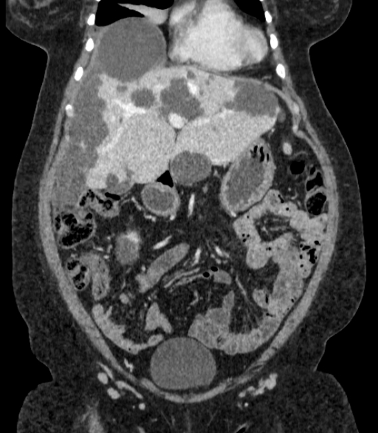 Autosomal dominant polycystic kidney disease (Radiopaedia 57124-64017 B 24).jpg