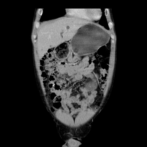 Autosomal dominant polycystic kidney disease (Radiopaedia 66349-75582 A 8).jpg