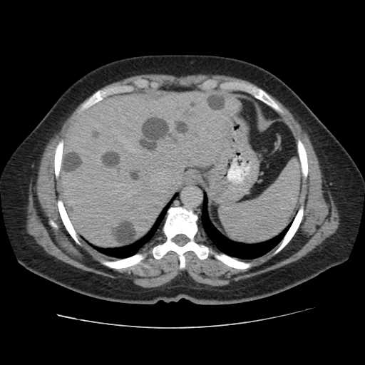 Autosomal dominant polycystic kidney disease with hepatic involvement (Radiopaedia 32693-33662 C 11).jpg