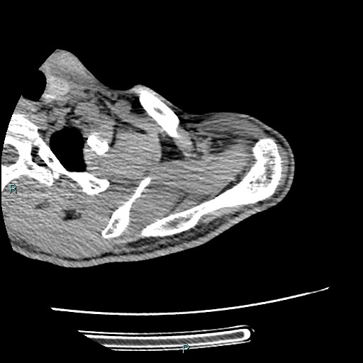 File:Avascular necrosis after fracture dislocations of the proximal humerus (Radiopaedia 88078-104655 D 30).jpg