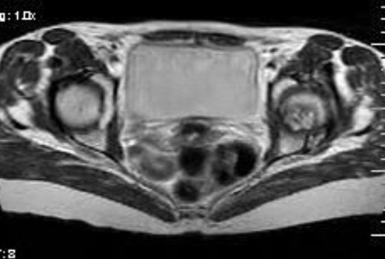 File:Avascular necrosis of hip (Radiopaedia 10061-10601 Axial T2 1).jpg