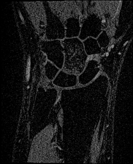 Avascular necrosis of the capitate (Radiopaedia 88317-104948 Coronal T1 vibe 34).jpg
