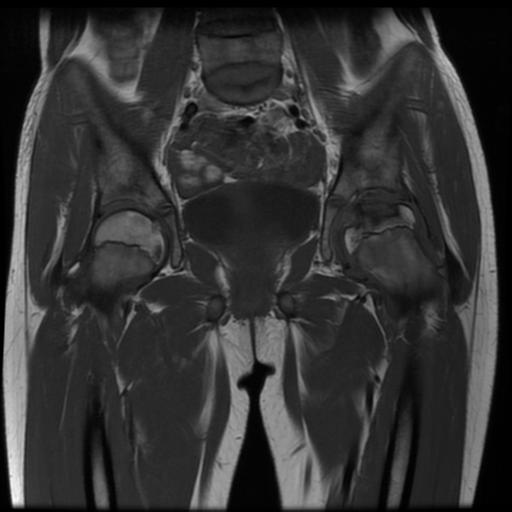 File:Avascular necrosis of the hip (Radiopaedia 29563-30067 Coronal T1 7).jpg