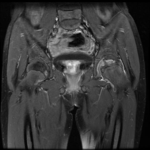 File:Avascular necrosis of the hip (Radiopaedia 29563-30067 I 7).jpg