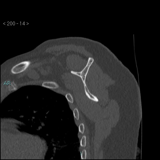 Avascular necrosis of the shoulder - Cruess stage I (Radiopaedia 77674-89887 Sagittal bone window 13).jpg