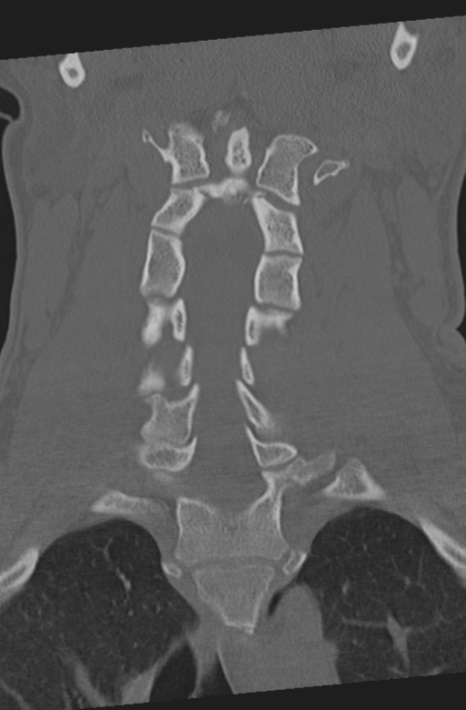 Axis peg fracture (type 3) and atlas lateral mass (type 4) fracture (Radiopaedia 37474-39324 Coronal bone window 23).png